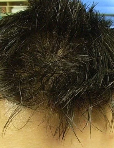 30 Male Early Pattern Hair Loss After Treatment