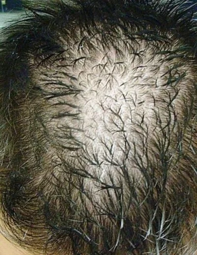 30 Male Early Pattern Hair Loss Before Treatment