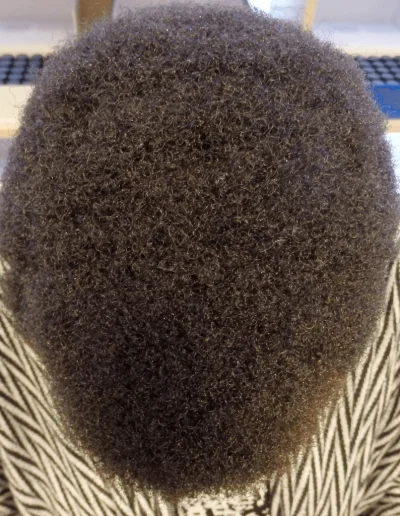 Traction Alopecia Treated