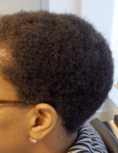 Hair Restoration For Traction Alopecia
