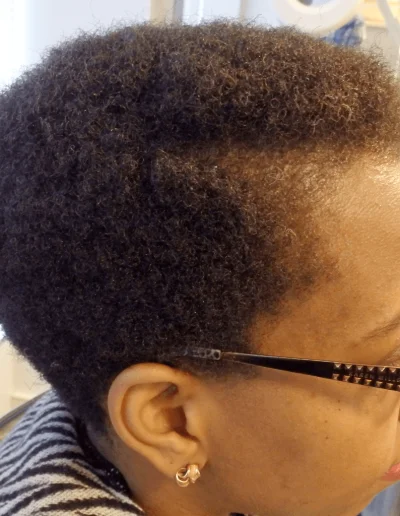 Traction Alopecia Regrowth