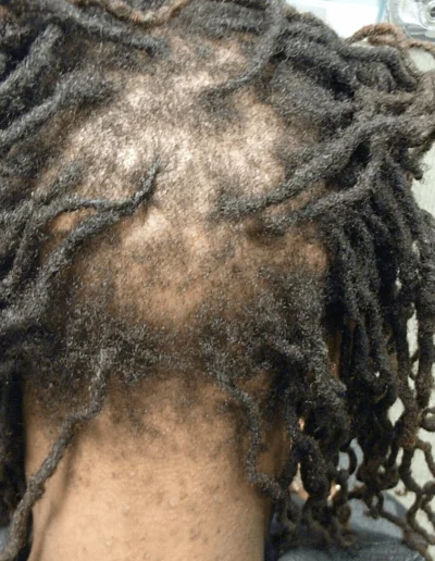 Severe Traction Alopecia