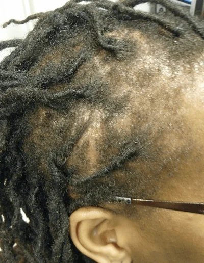 Traction Alopecia Signs