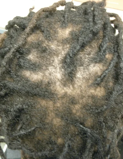 Traction Alopecia Symptoms