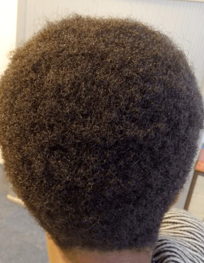Traction Alopecia Traeted