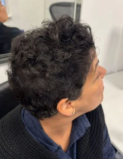 Leah after alopecia areata treatment — full hair regrowth