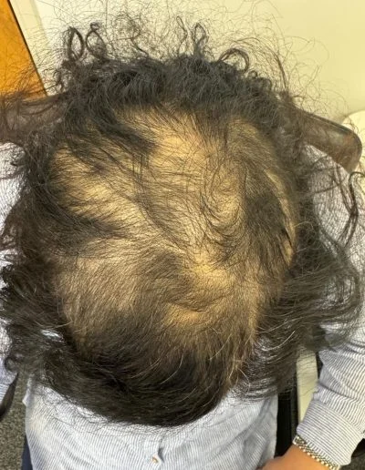 Leah before alopecia areata treatment — total scalp hair loss