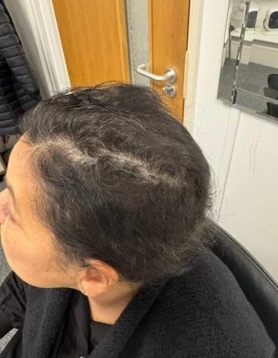 Leah — Early signs of Alopecia Areata regrowth