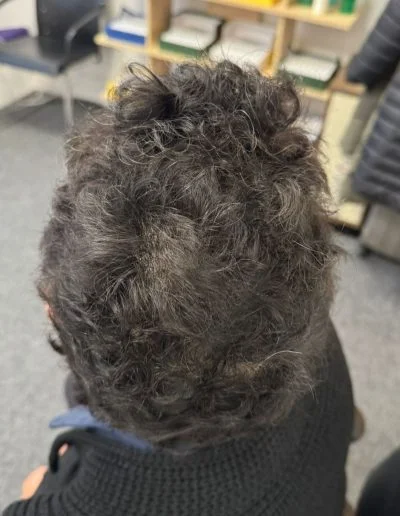 Leah midway through alopecia areata treatment — early regrowth visible