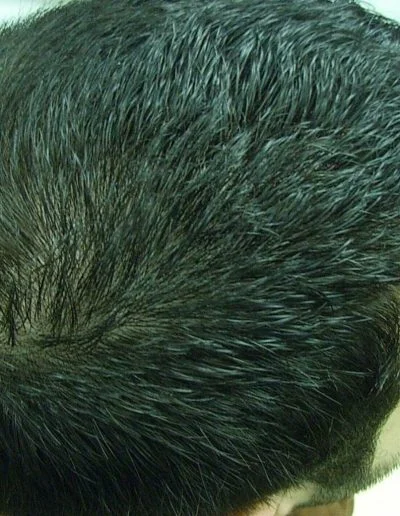 Mark Male Pattern Baldness — After