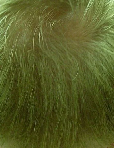 Martin after treatment — Male Pattern Baldness
