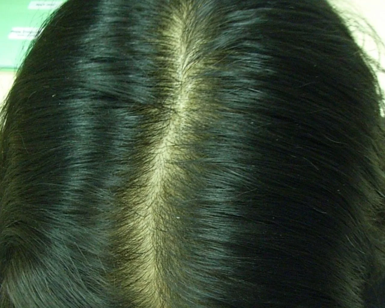 Mary — Female Pattern Balding after treatment