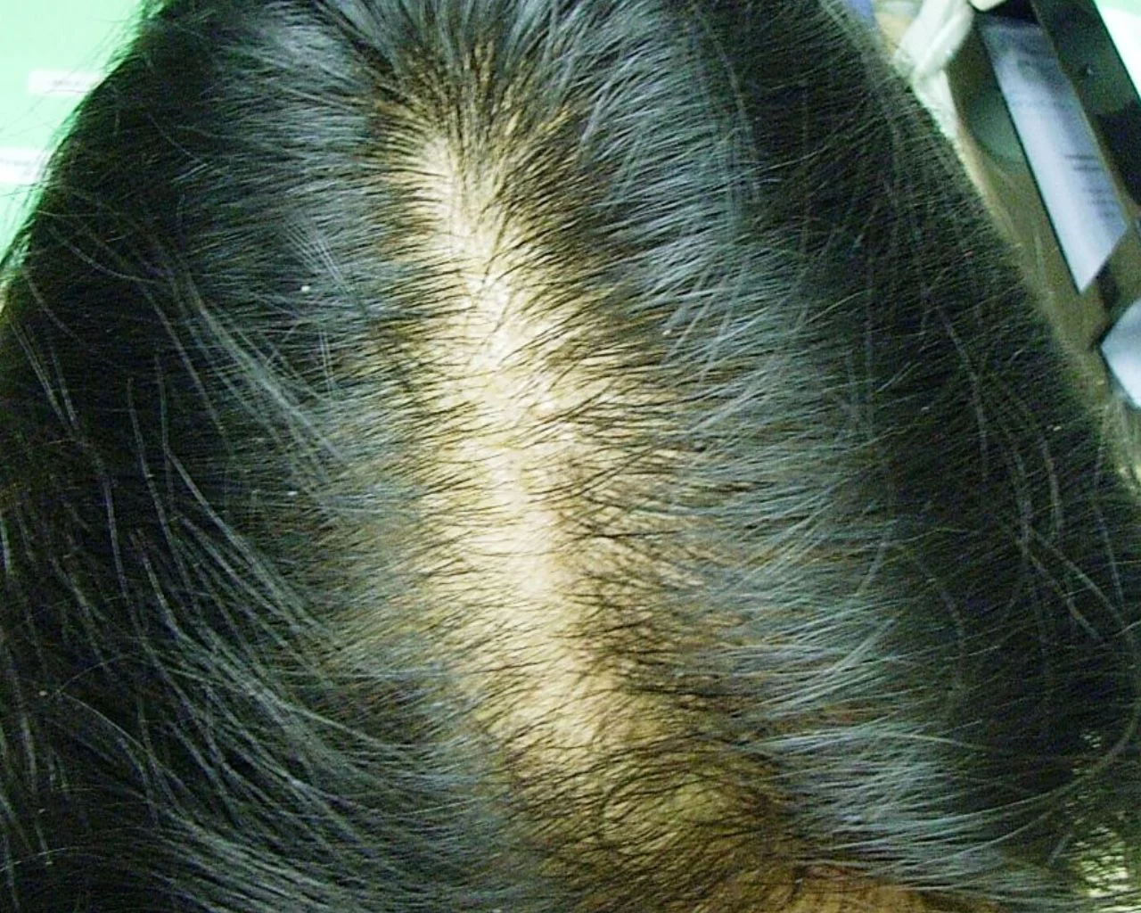 Mary — Female Pattern Balding before treatment