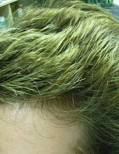 Merlin after treatment — Male Pattern Baldness
