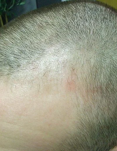 Merlin before treatment — Male Pattern Baldness