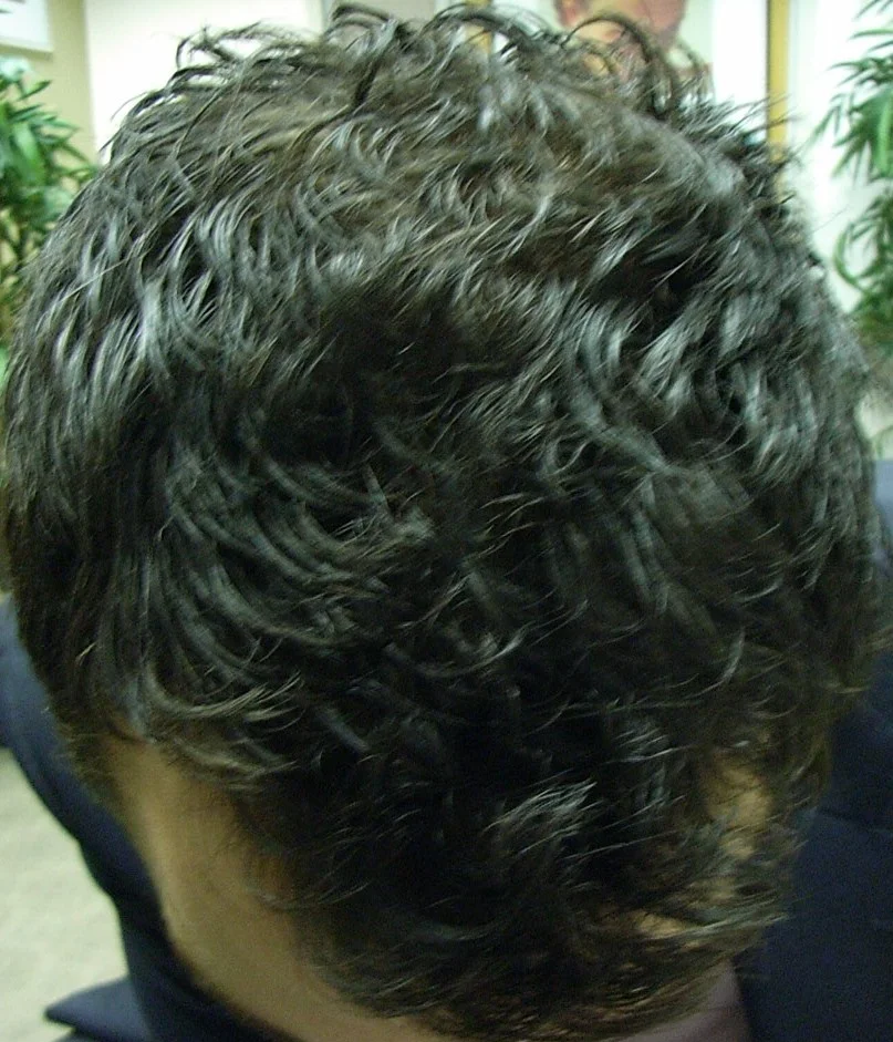 Mike after male pattern baldness treatment results