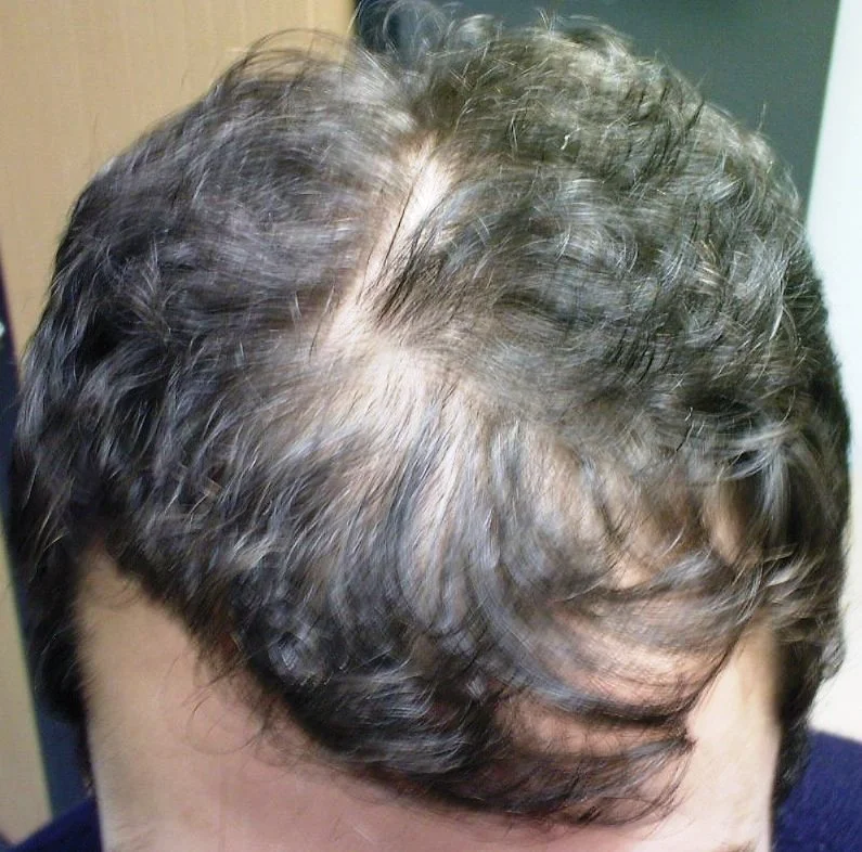 Mike before male pattern baldness treatment at The Hair Centre