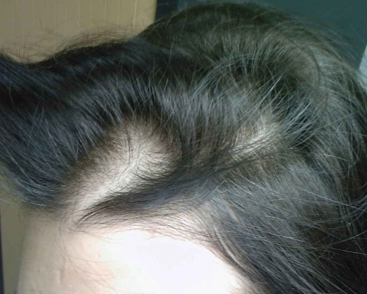 Nadia before treatment — Female Pattern Balding