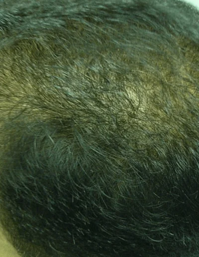 Asian Male Hair Loss 49 Post Treatment