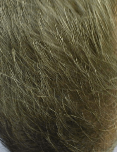 Paul Male Pattern Baldness — After
