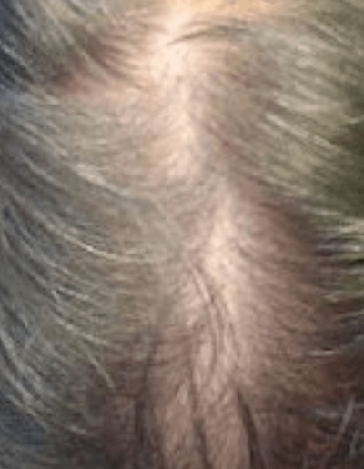 Paul Male Pattern Baldness — Before