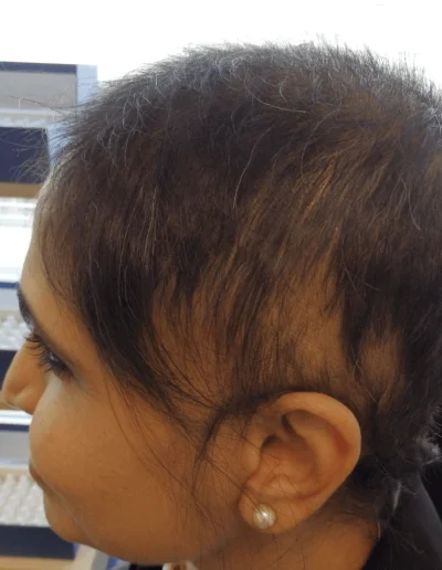 Priya midway through telogen effluvium treatment
