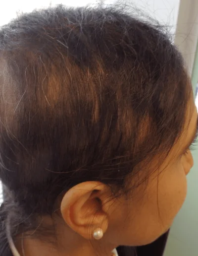 Priya Mid Treatment