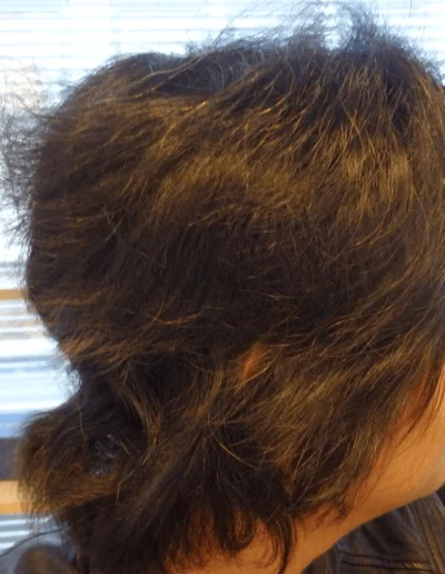 Priya after full recovery from telogen effluvium