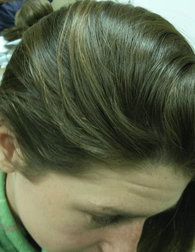 Rachel Alopecia Treated