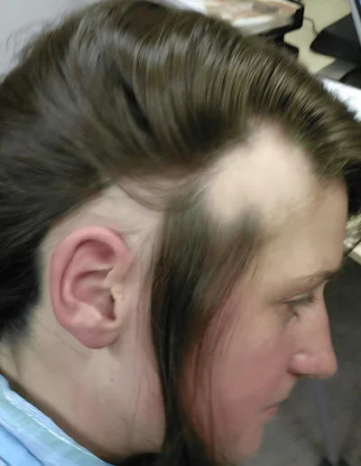 Rachel Alopecia