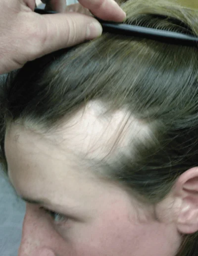 Rachel Mid Alopecia Treatment