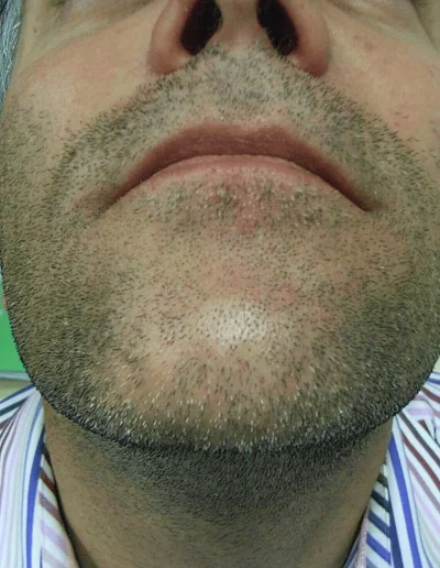 Treated Beard Alopecia