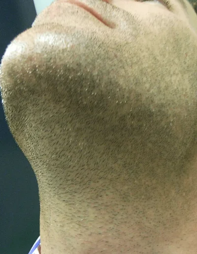 Beard Bald Patches Post Treatment