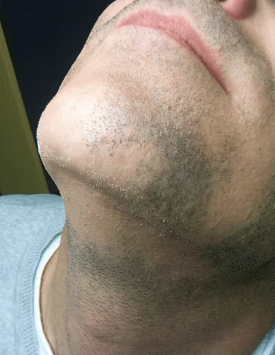 Facial Bald Spots