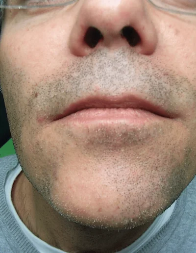 Facial Hair Thinning