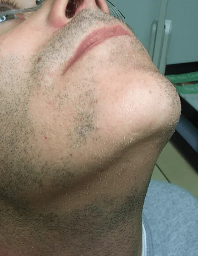 Patchy Beard Loss Alopecia Barbae