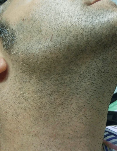Beard Hair Loss Recovery