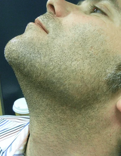 Alopecia Barbae Treated