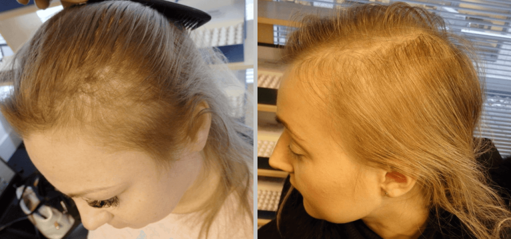 PCOS Hair Loss in Women