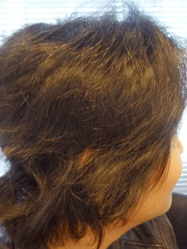 After treatment - Telogen Effluvium