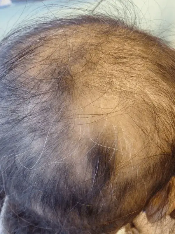 Before treatment - Telogen Effluvium
