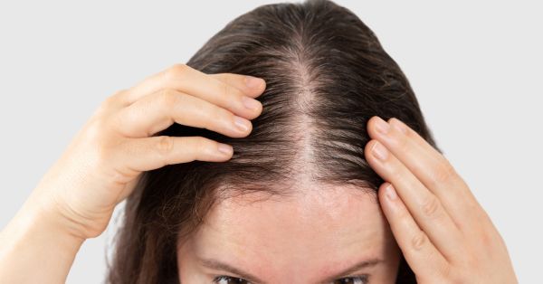 Telogen Effluvium treatments