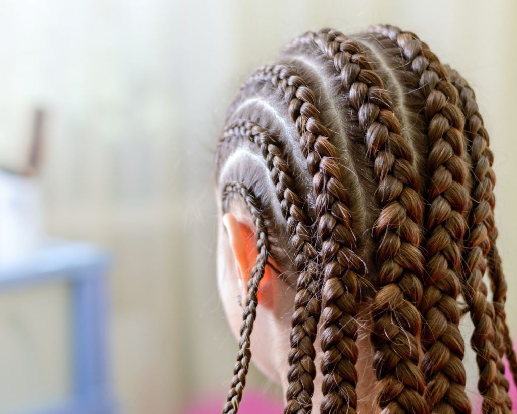 Tight hair braids causing traction alopecia